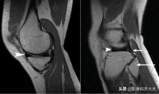 膝關節半月闆損傷mri怎麼看（膝關節半月闆損傷的磁共振）7