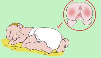 尿布疹如何預防與護理（要想寶寶遠離尿布疹）1