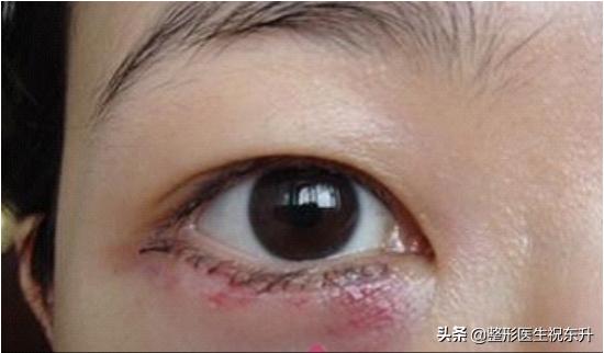 眼袋手術後眼睑外翻修複案例（做完眼袋手術有點睑外翻）1