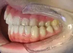 遺傳性牙颌畸形的主要表現方式（孩子的這20種牙颌畸形問題需要在12歲前解決）3