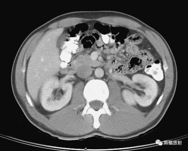 肝總管ct解剖位置（收藏上腹部CT斷層）39