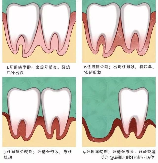 為什麼最近牙龈老出血（為什麼你的牙龈總是出血）1