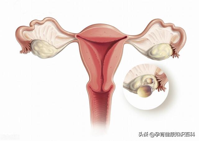 卵巢囊腫導緻不孕怎麼辦（卵巢囊腫是如何導緻不孕的）1