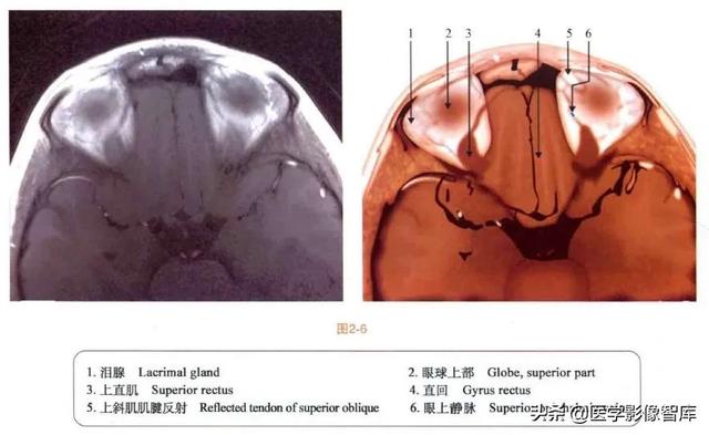 ct與mri斷層解剖學袖珍圖譜電子版（眼眶MRI斷層解剖速查圖譜）7