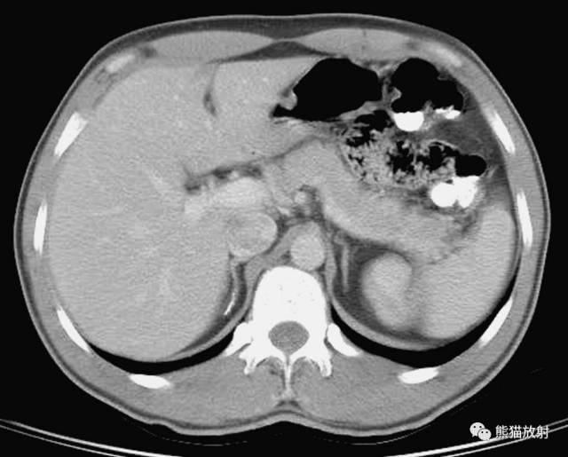 肝總管ct解剖位置（收藏上腹部CT斷層）14