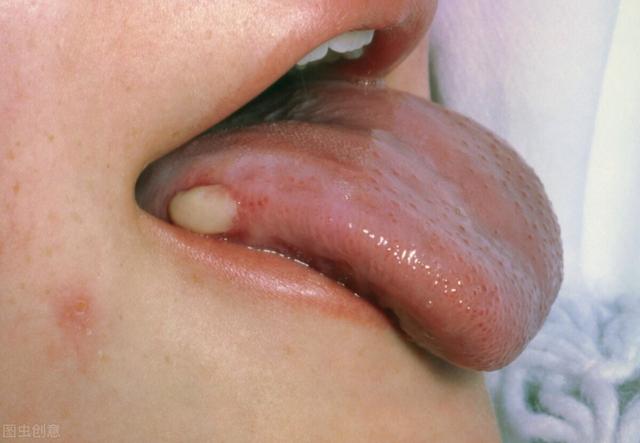 口腔潰瘍吃哪種維c效果好（有種痛叫口腔潰瘍）6