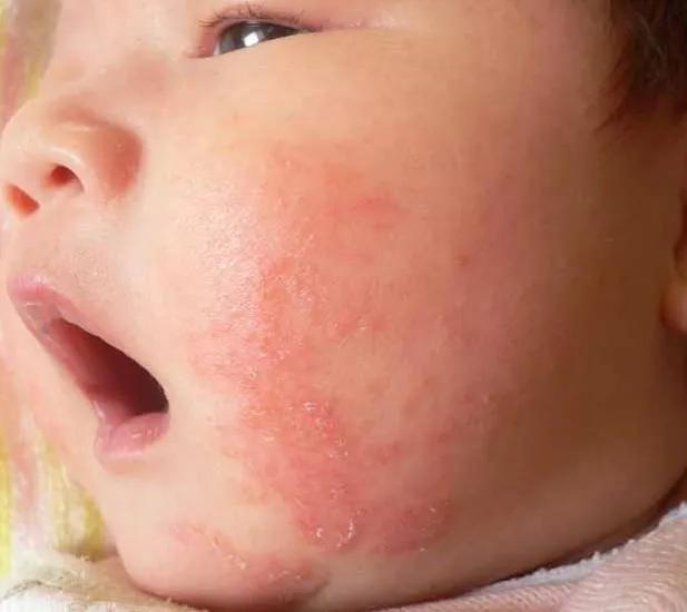 一個多月寶寶過敏性咳嗽怎麼辦（寶寶咳嗽1月治療不見好轉）1