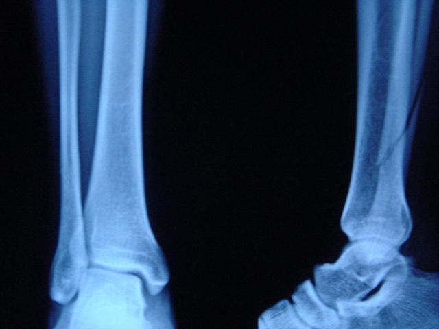 腳踝骨折三月後發燙什麼原因（腳踝骨折一個多月了）2