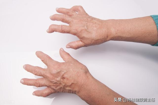 類風濕性關節炎手指僵硬（手指出現僵硬就代表着有類風濕性關節炎嗎）2