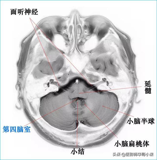 聽影像大咖講顱腦ct解剖（顱腦磁共振MRI解剖結構以及高清圖譜）19
