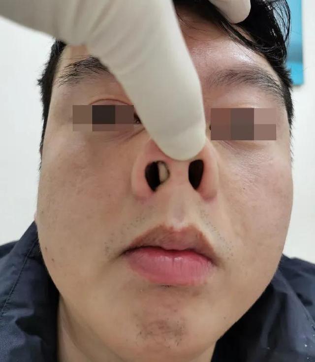 鼻中隔一側嚴重偏曲保守治療辦法（嚴重鼻中隔偏曲患者需手術治療）1