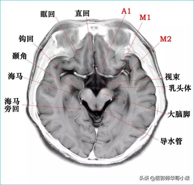 聽影像大咖講顱腦ct解剖（顱腦磁共振MRI解剖結構以及高清圖譜）14