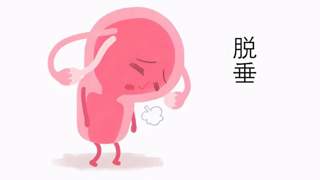 懷孕期間查出宮頸病變（孕期突發子宮脫垂）2