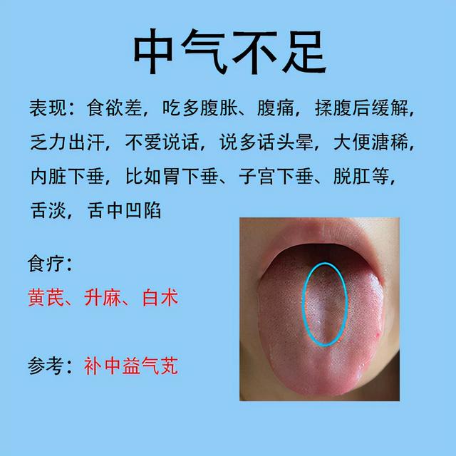 舌齒痕脾胃虛弱舌象圖（脾胃不好常見的六種舌象）6