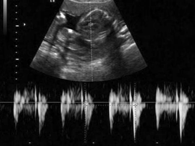 怎麼根據胎兒電子檢測算出孕周期（明明白白做超聲）5