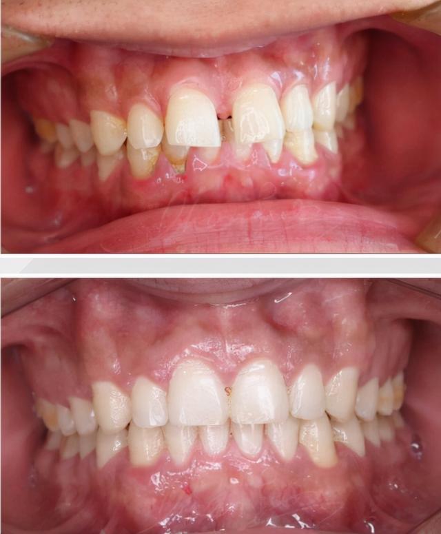 重慶種牙好還是鑲牙好（深覆合不僅影響你的口腔健康）9