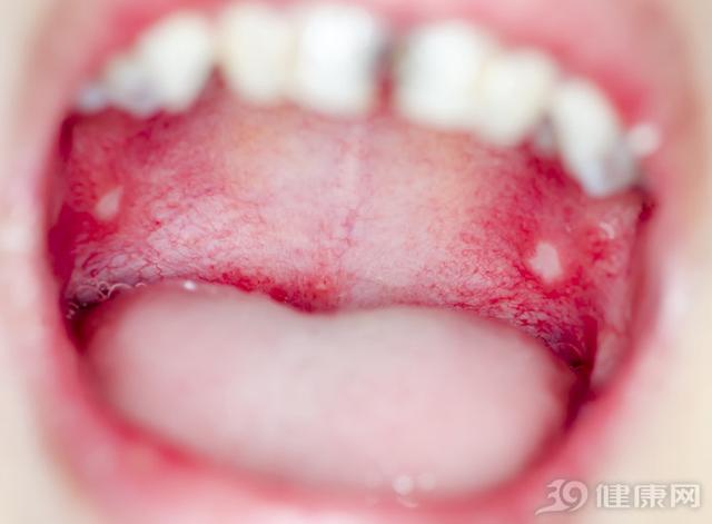 牙癌是什麼原因導緻的舌癌（口腔潰瘍超過2周沒痊愈）5