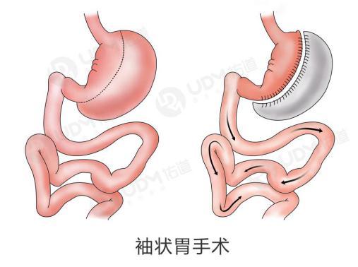 胃切除和胃轉流哪個效果好（胃轉流手術與胃切除手術哪個好）1