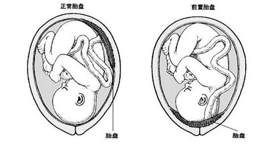 懷孕胎盤前壁要注意什麼（胎盤位于前壁會有危險嗎）2