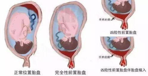 懷孕胎盤前壁要注意什麼（胎盤位于前壁會有危險嗎）3