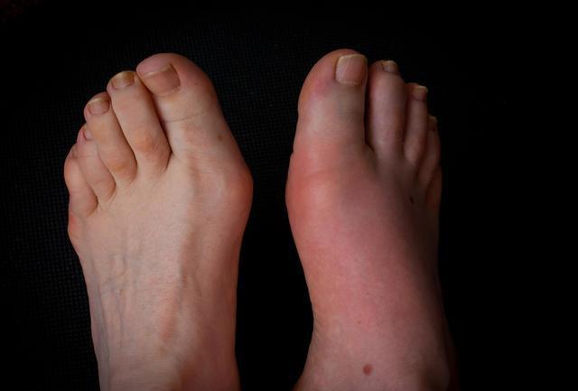 尿毒症患者腳趾疼是怎麼回事（從腳趾痛到尿毒症）1