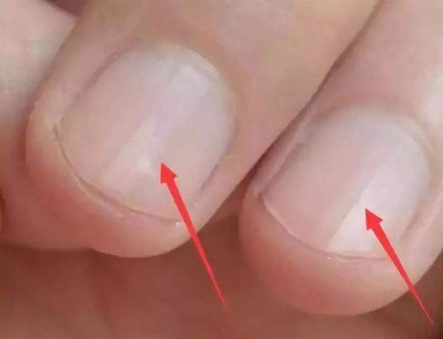 指甲上的月牙少是不健康的标志麼（是不是身體不好）7