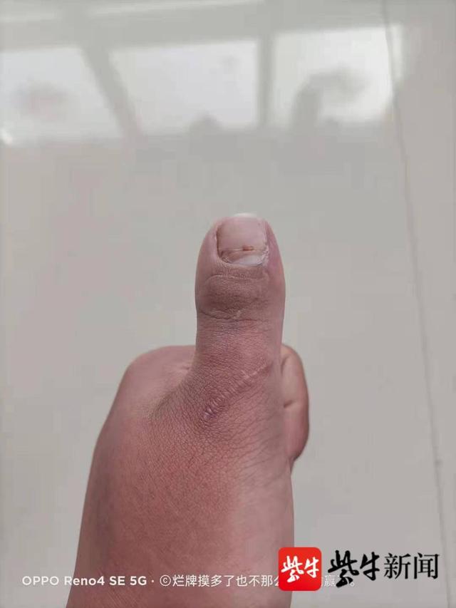 腳趾頭小拇指為什麼老長小指甲（這靈活的大拇指）1