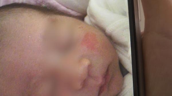 四個月寶寶皮膚一塊塊粗糙（四月齡嬰兒皮膚大面積出現問題）5