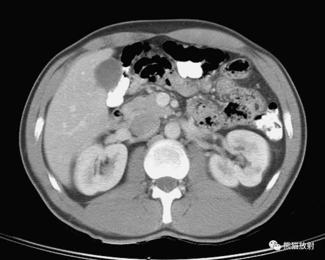 肝總管ct解剖位置（收藏上腹部CT斷層）35