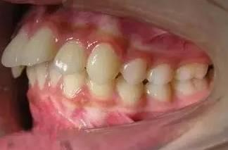 牙颌畸形的基本分類（這20種牙颌畸形問題需要在12歲前解決）4