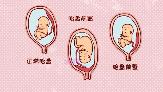 孕期胎盤前置多久能長上去（孕期胎盤前置不要害怕）5