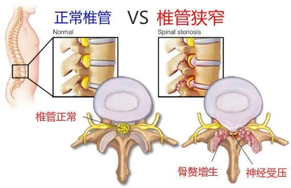 腰椎管狹窄隻有手術才能根治嗎（腰椎管狹窄怎麼辦）2