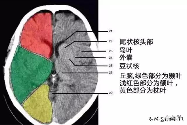 正确認識顱腦ct解剖圖譜（解剖影像）18