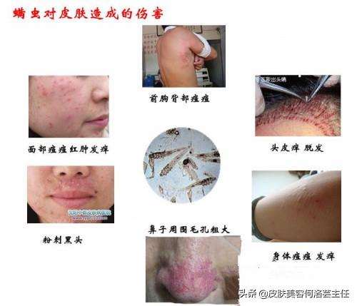 上海硫磺皂的作用去螨蟲（3元一塊的硫磺皂洗臉去螨蟲）5