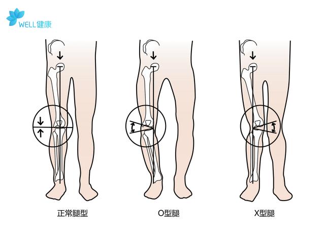 7歲小孩o型腿嚴重怎麼矯正腿型（家長們掌握這3種方法）1