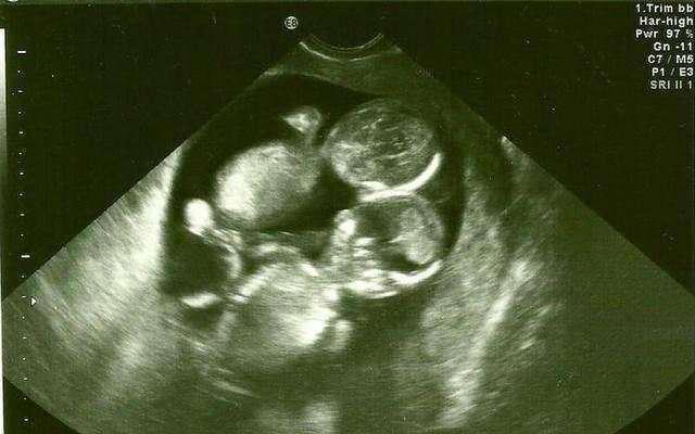 懷孕雙胞胎在踢肚子（發現雙胞胎寶寶在媽媽肚中互揍對方）1