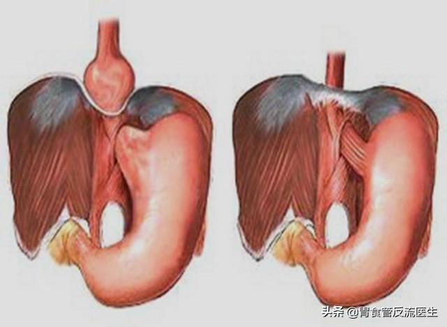 食管裂孔疝會引起左下腹疼痛嗎（食管裂孔疝的出現）2