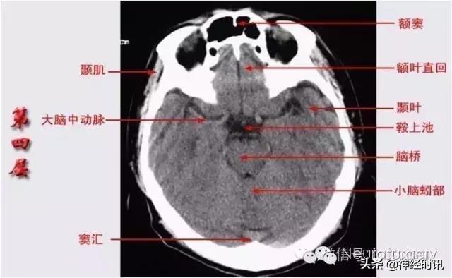 正确認識顱腦ct解剖圖譜（解剖影像）6