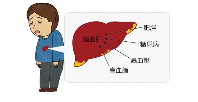 脂肪肝是怎樣引起的要怎樣預防（脂肪肝的常見症狀有哪些）2