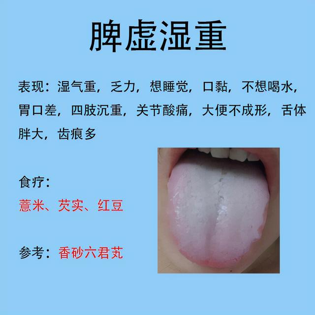 舌齒痕脾胃虛弱舌象圖（脾胃不好常見的六種舌象）4