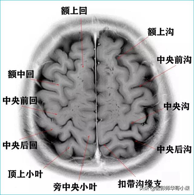 聽影像大咖講顱腦ct解剖（顱腦磁共振MRI解剖結構以及高清圖譜）4