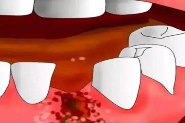 舌苔厚白是牙周炎怎麼回事（牙龈腫滲血可能不是上火）4