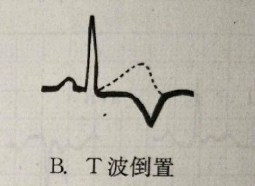 心電圖t波異常前壁心肌缺血嚴重嗎（心電圖T波改變就是心肌缺血）5