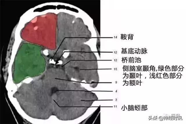 正确認識顱腦ct解剖圖譜（解剖影像）15