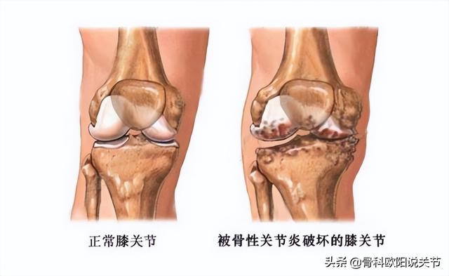 膝關節疼痛診治經驗（膝關節疼痛的發病原因）2