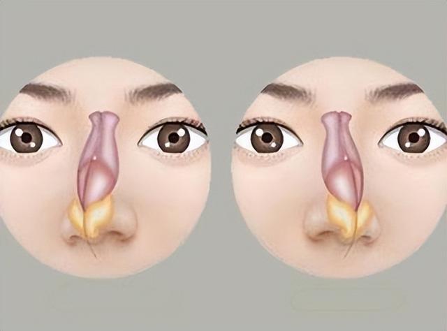 鼻中隔彎曲需要整形手術嗎（鼻整形中可以矯正鼻中隔偏曲嗎）5