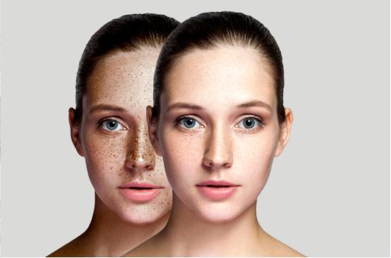 臉上的色斑越來越多了是什麼原因（為什麼你的臉上色斑頻發）1