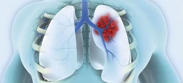 一般得了肺癌晚期能活多久（患者會經曆什麼）4