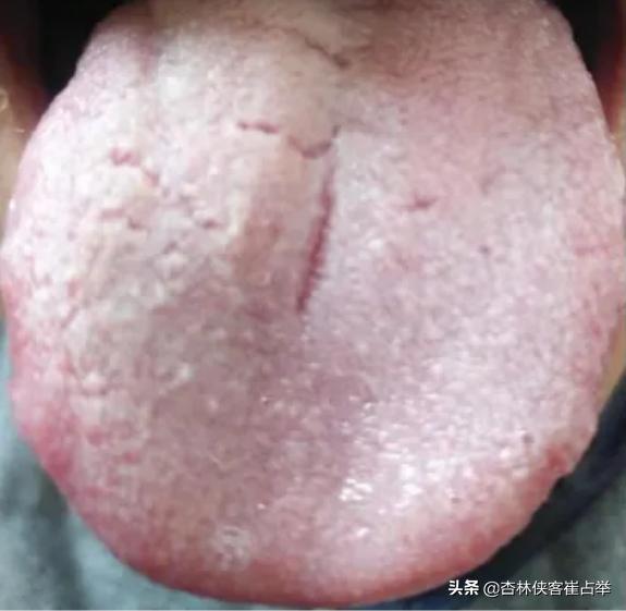 舌頭裂紋是什麼造成的怎麼恢複（舌頭有很多裂紋怎麼辦）3