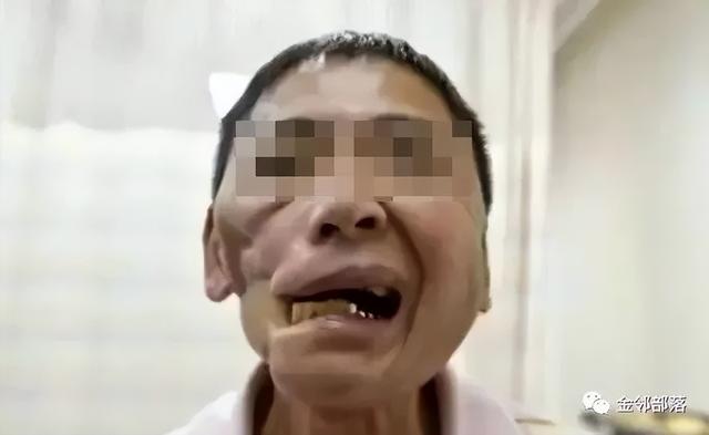 吃槟榔的人是不是活不到40歲（男歌手口腔癌去世）4